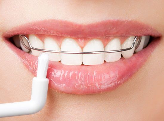 Traditional braces and dental alignment