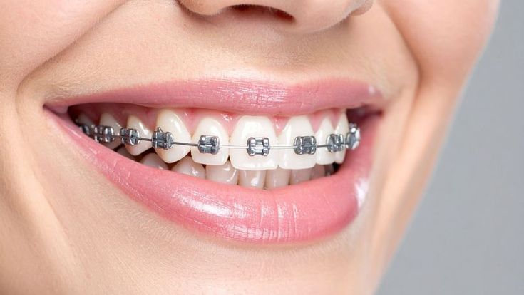 Consultation about ceramic braces