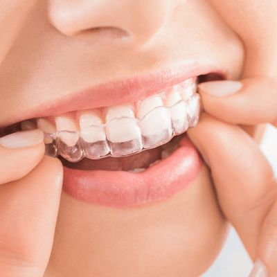 Clear aligners and teeth straightening consultation