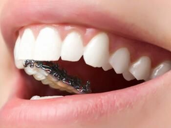 Orthodontic assessment for lingual braces